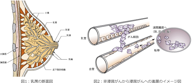 [図1]乳房の断面図・[図2]非浸潤がんから浸潤がんへの進展のイメージ図